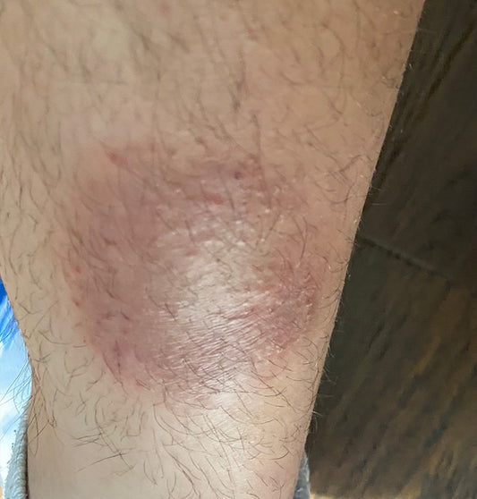 Discoid Eczema