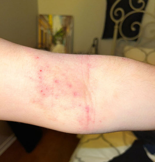 Eczema